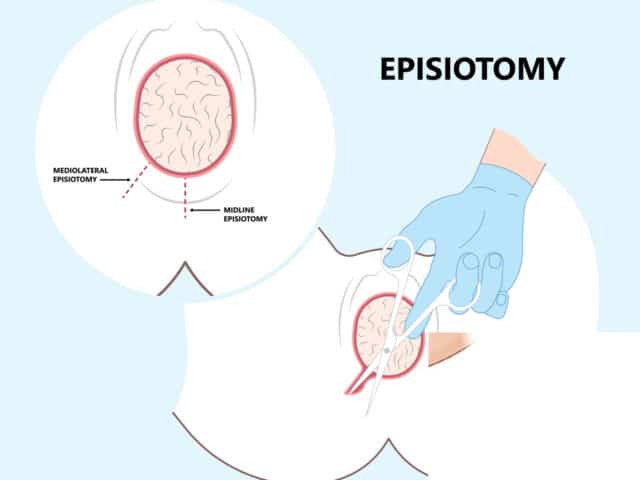 episiotomy incision