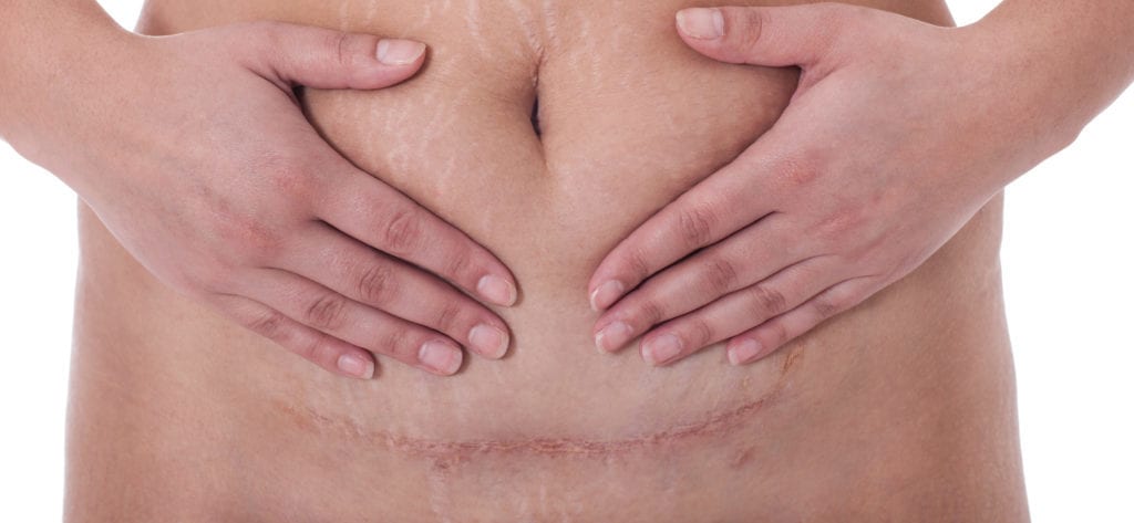 Caesarean section scars: photos