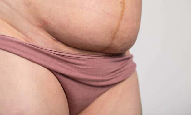 The seam on the abdomen of a woman after a caesarean section. Recovery of the female body after the birth of a child, complications.